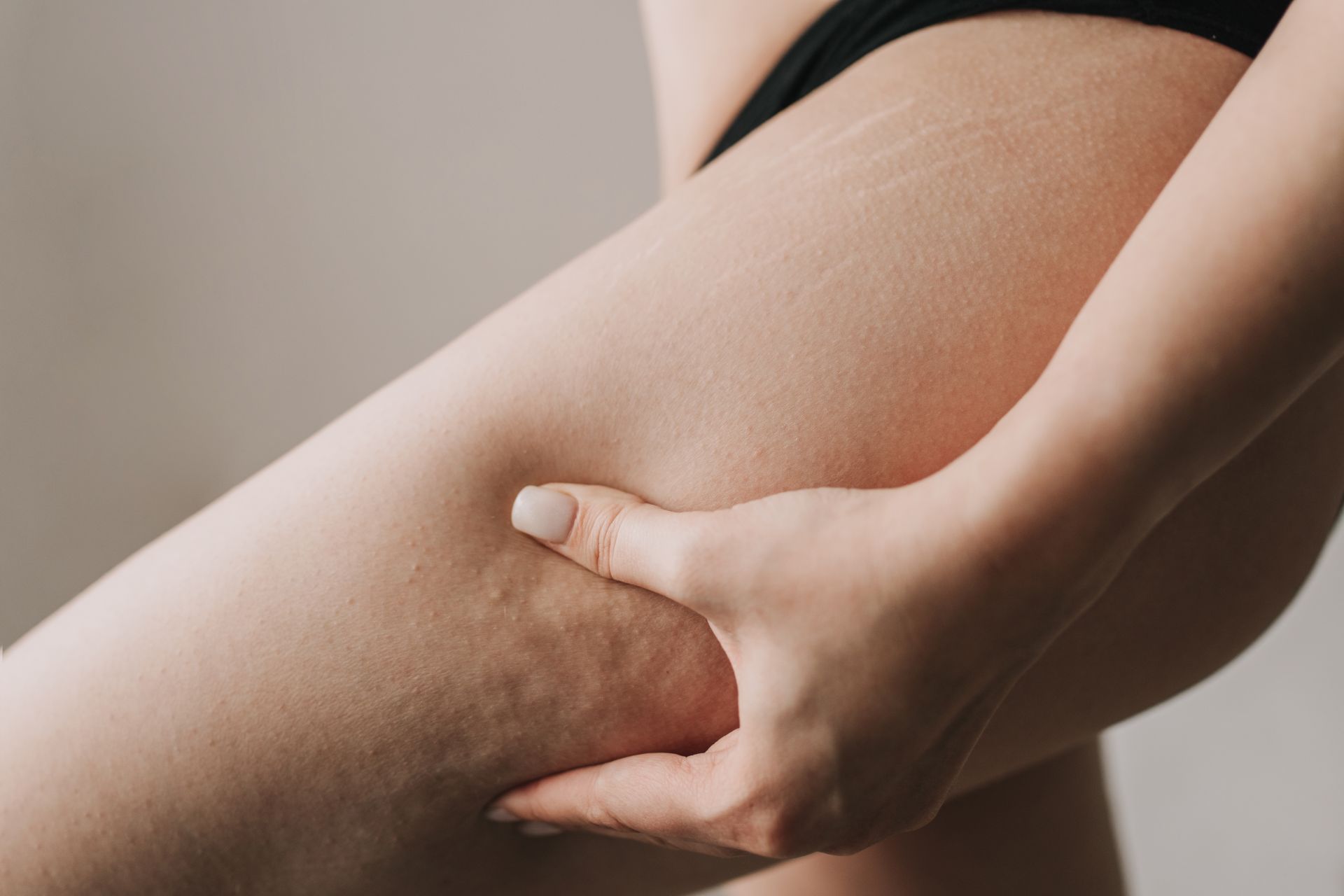 Cellulite - how to prevent it?